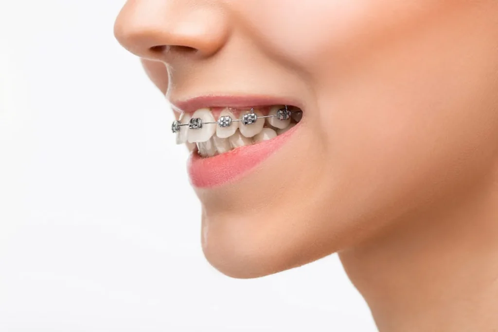 Brackets Polanco