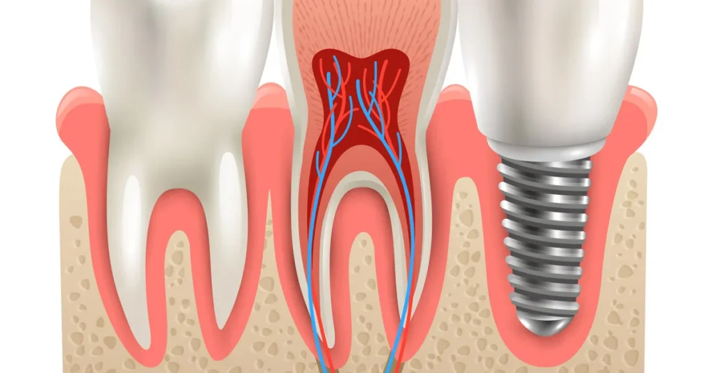 Implantólogo en Polanco