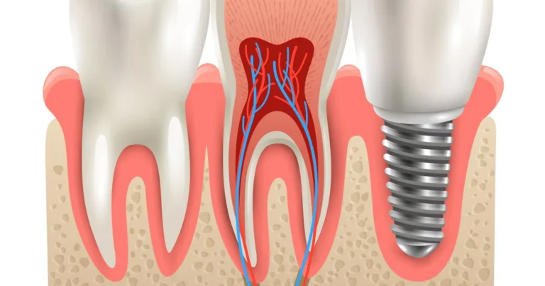 Implantólogo en Polanco