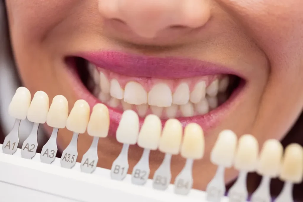 Blanqueamiento Dental Polanco
