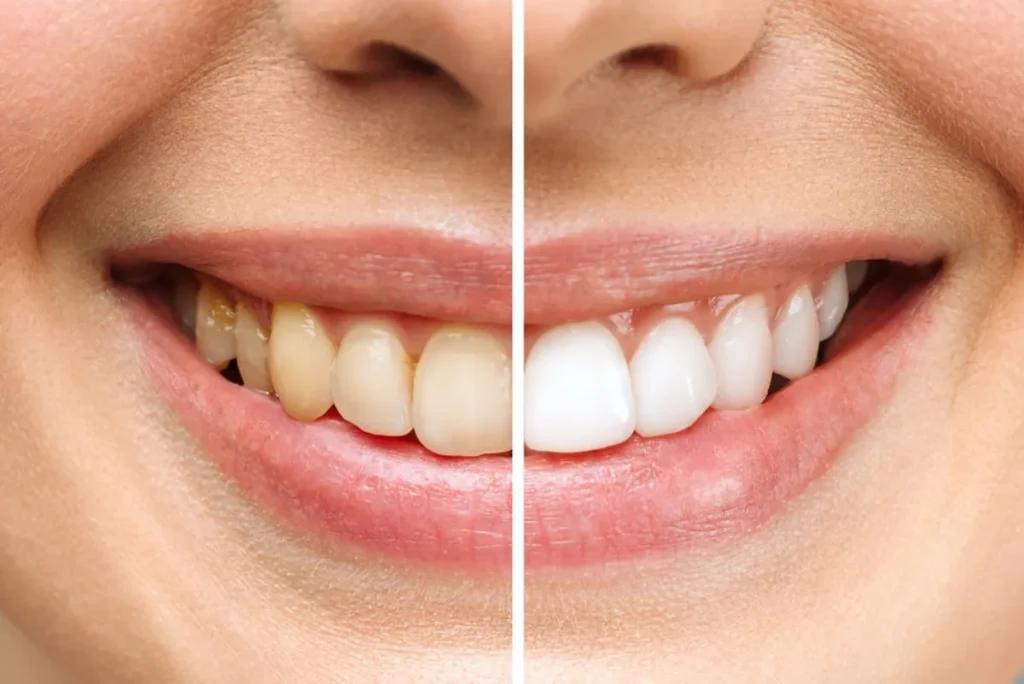 Blanqueamiento Dental Zoom