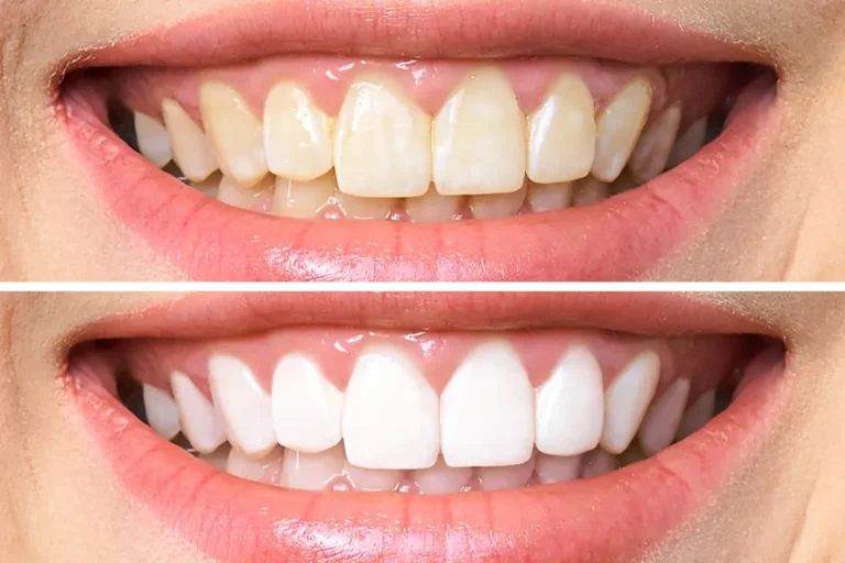 Blanqueamiento Dental