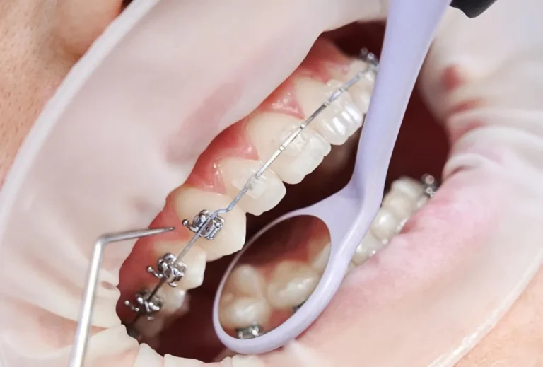 Brackets de zafiro