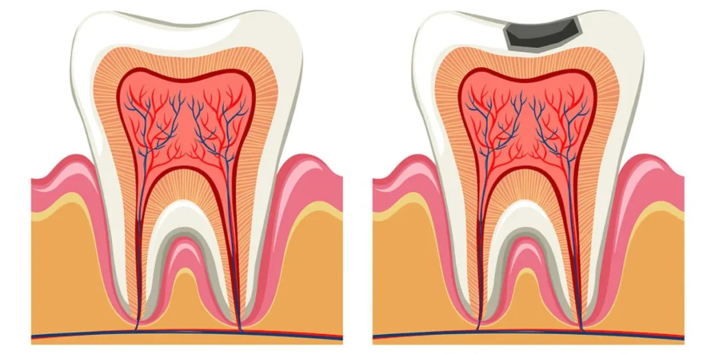 Coste de la caries dental