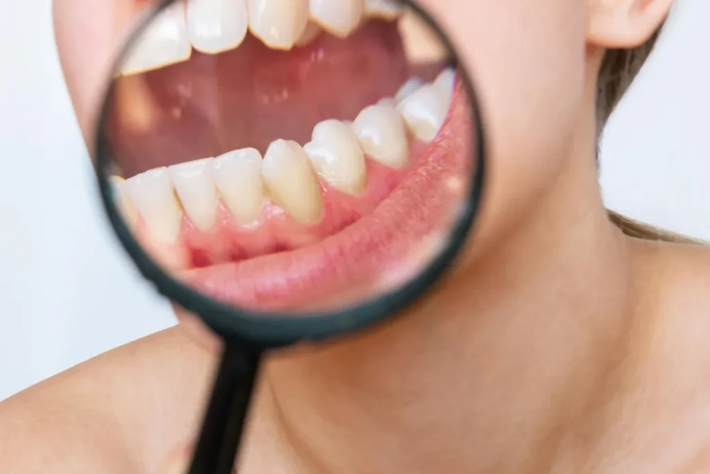 La caries dental Polanco