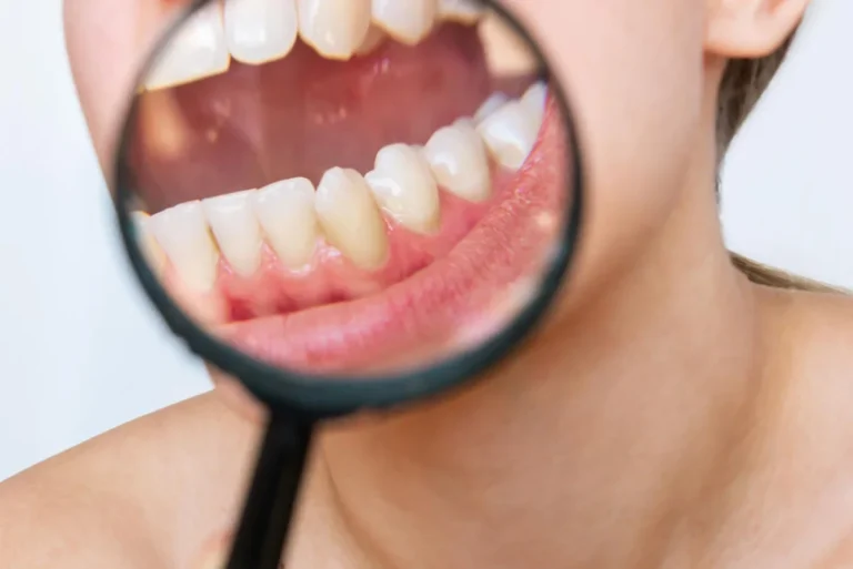La caries dental Polanco
