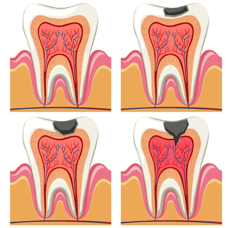 Caries Dental Estadios