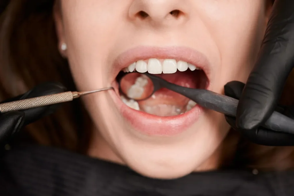 Quitar caries Polanco