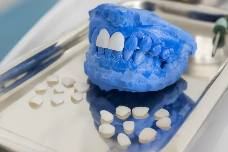 Carillas dentales: tipos y costos