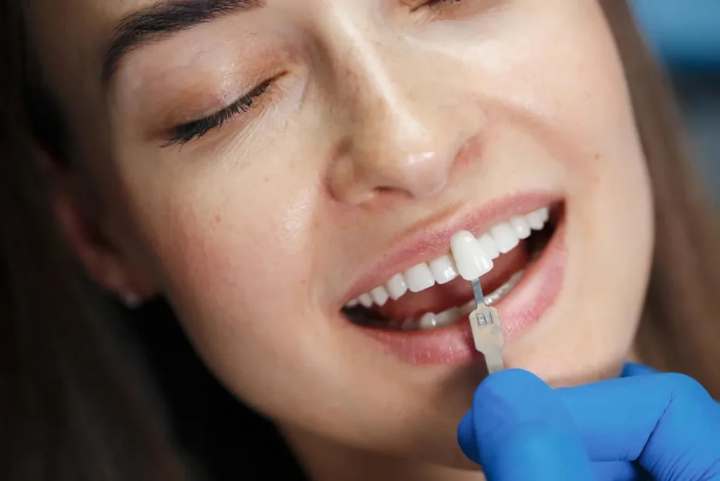 Diseño de Sonrisa con Carillas