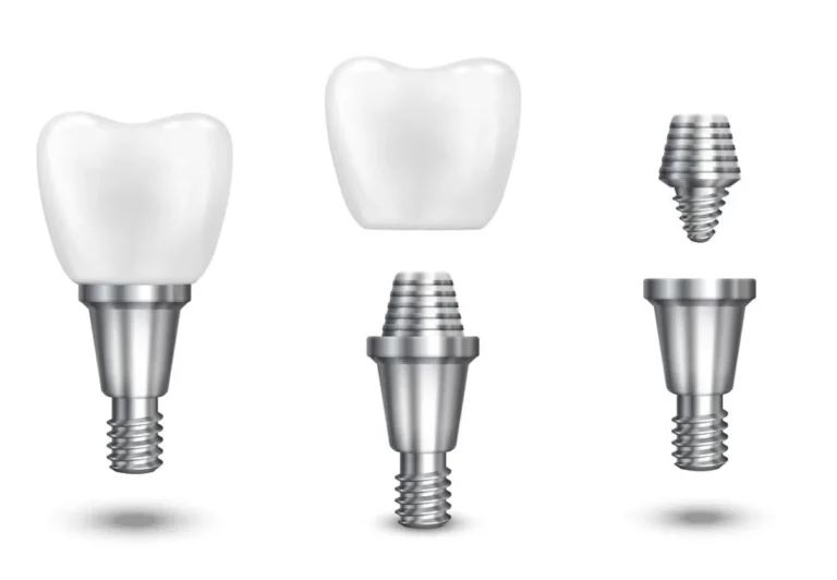 Implantólogo Polanco