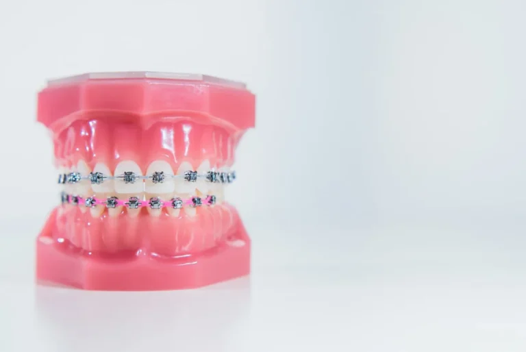 ¿Cómo cuidar tus brackets? Ciudad de México