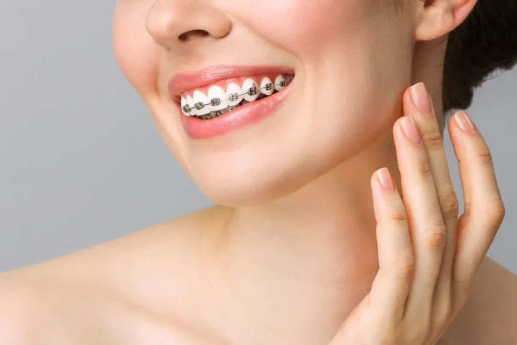 Brackets metálicos