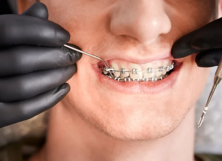 Brackets en Polanco