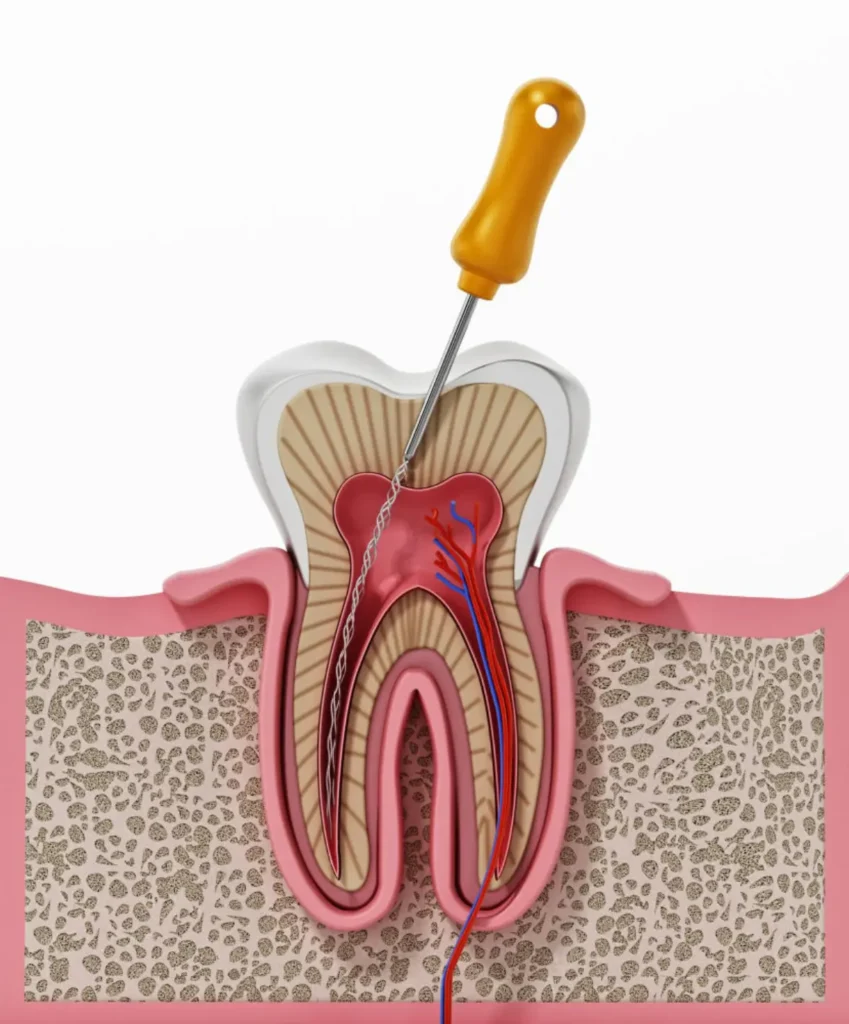 Endodoncista en Polanco