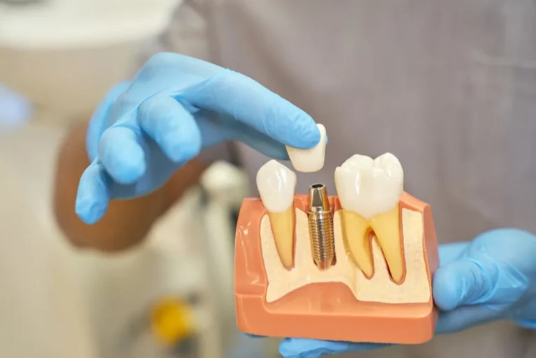 Implantes dentales Polanco