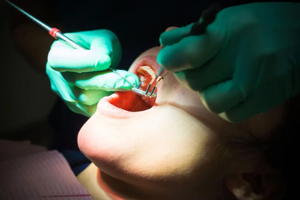 Fluorosis dental: causas y prevención