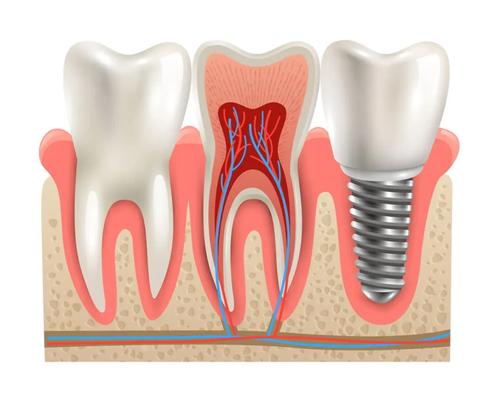 Implante Dental Polanco