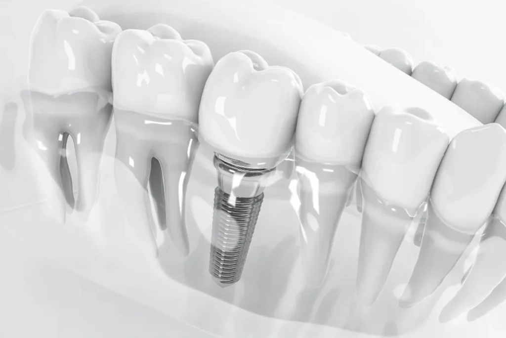 Precio de Implantes Dentales en México 2023
