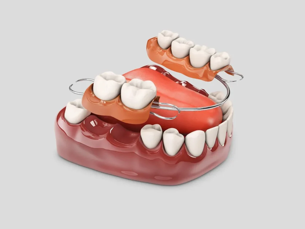 Protesis Dental