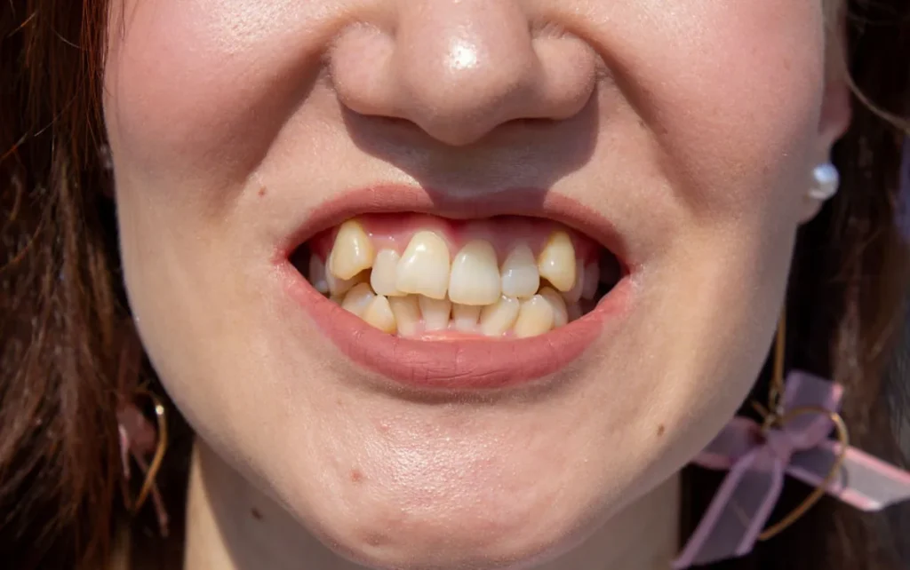 Dientes chuecos