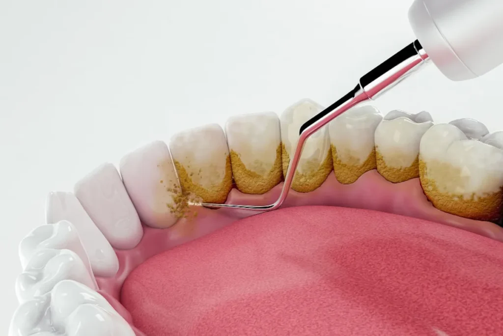 Limpieza dental Polanco