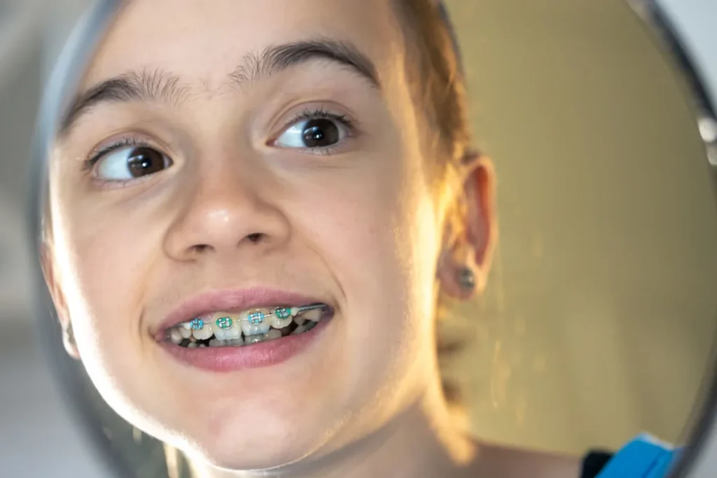 Brackets para niños
