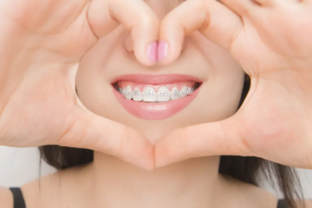 brackets autoligados