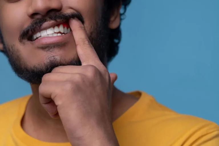 Gingivitis