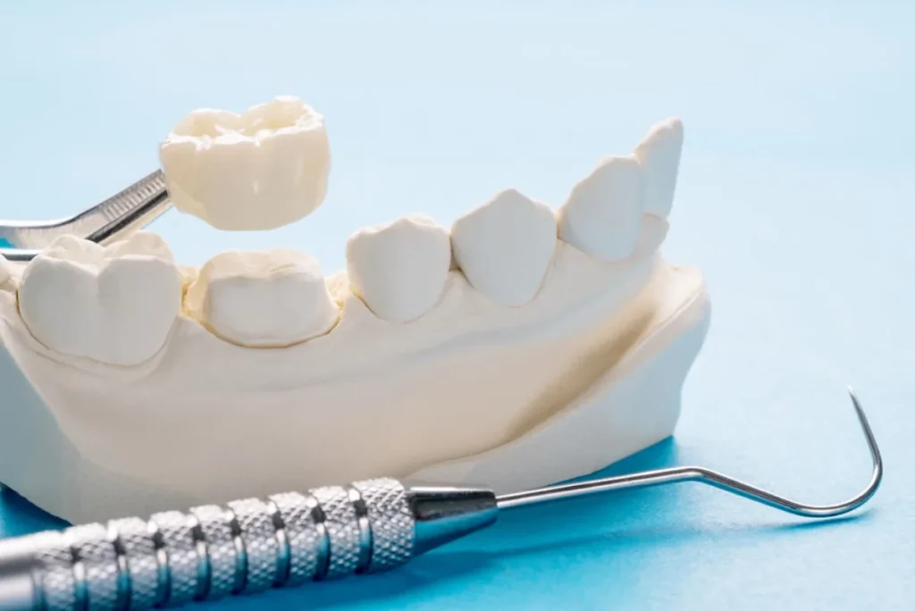 Corona dental coste