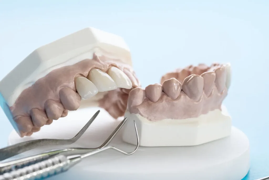 Puente dental