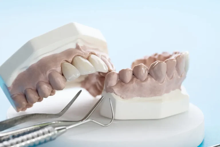 Puente dental