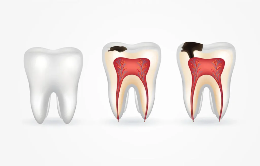 Caries Dental