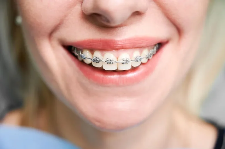 Brackets en Polanco