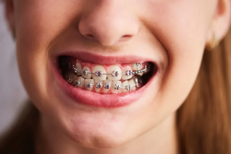 Tipos de Brackets