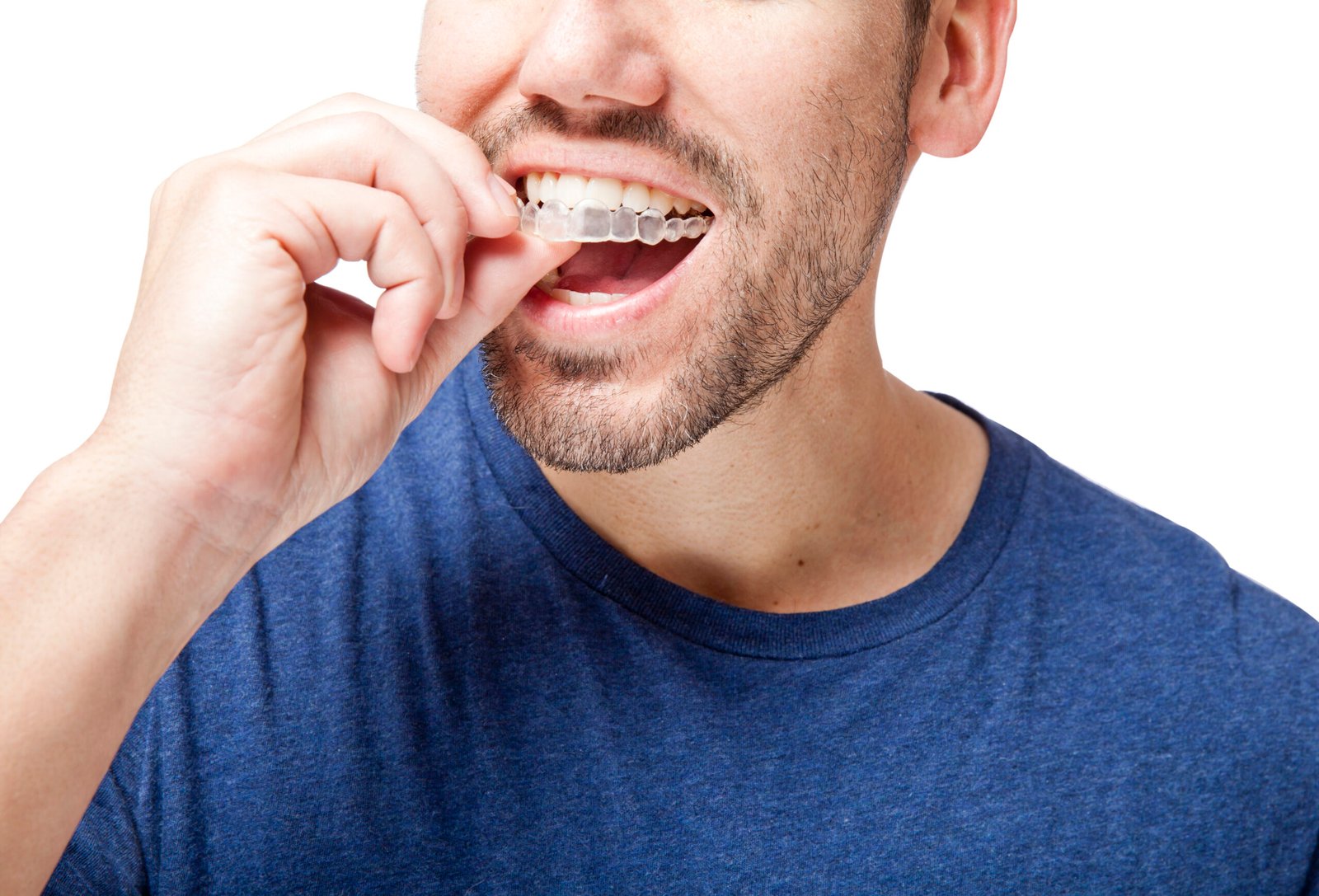 Paciente Siroco Aligners