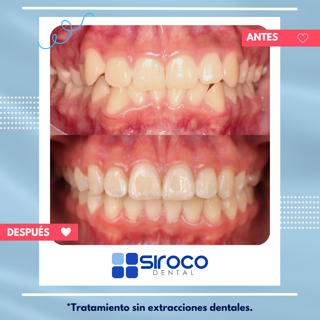 Caso antes y después 1