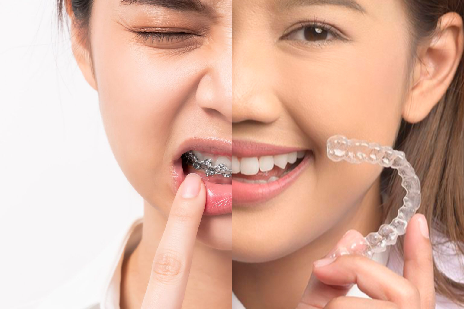 Comparativa alineadores vs brackets