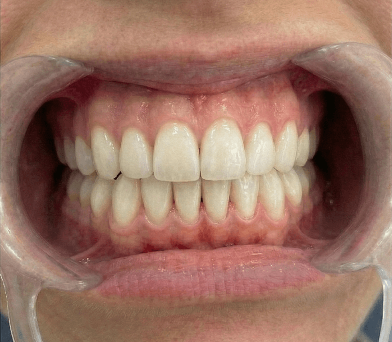 Dientes después del blanqueamiento Zoom