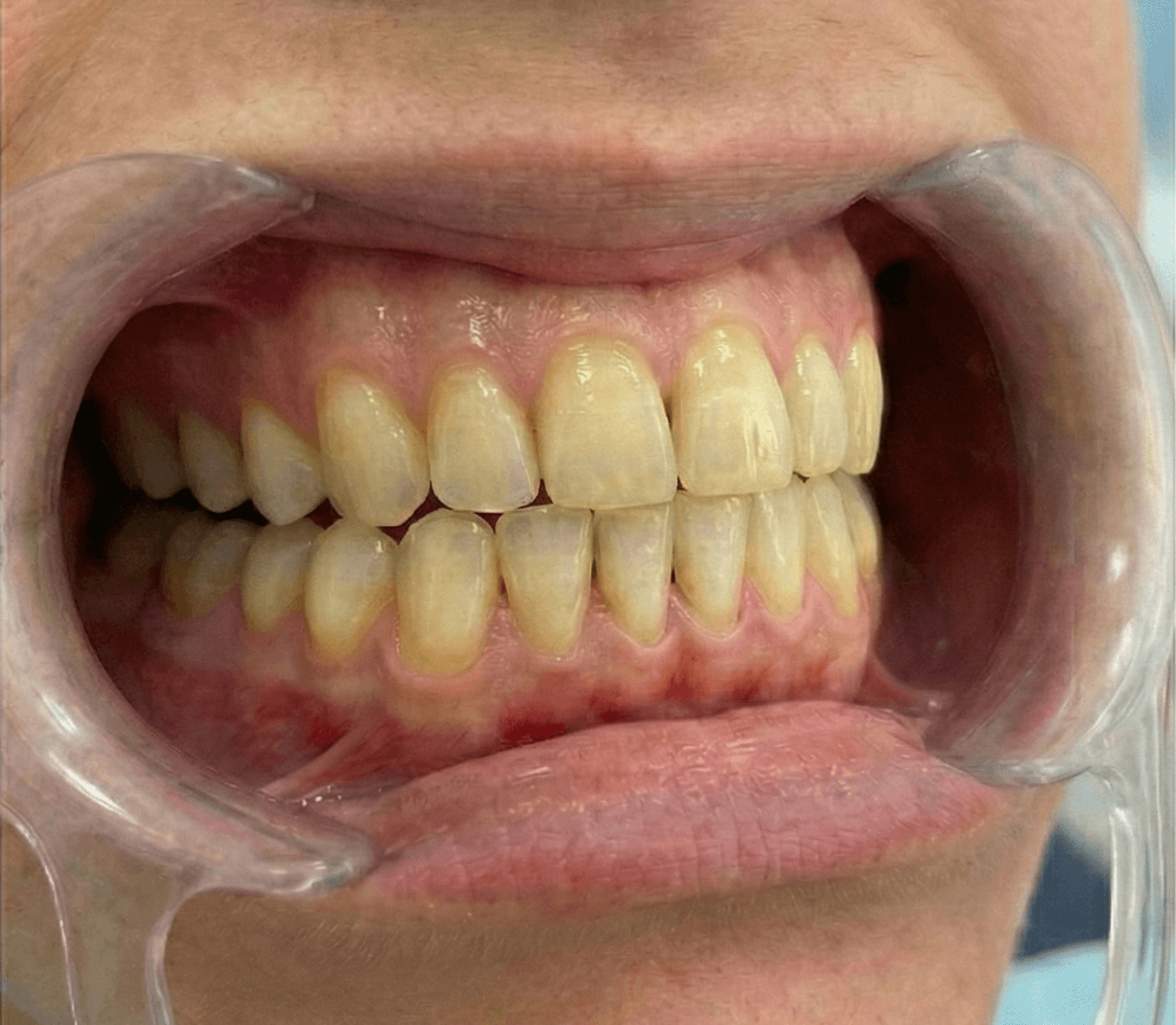 Dientes antes del blanqueamiento Philips Zoom — Siroco Dental Polanco